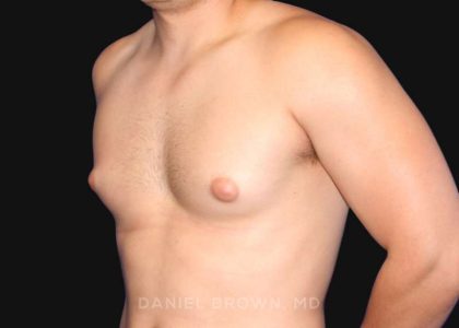 Gynecomastia Before & After Patient #10000