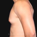 Gynecomastia Before & After Patient #10000