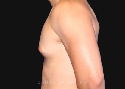 Gynecomastia Before & After Patient #10000