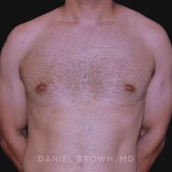 Gynecomastia Before & After Patient #10011