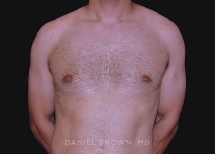 Gynecomastia Before & After Patient #10011