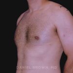 Gynecomastia Before & After Patient #10011