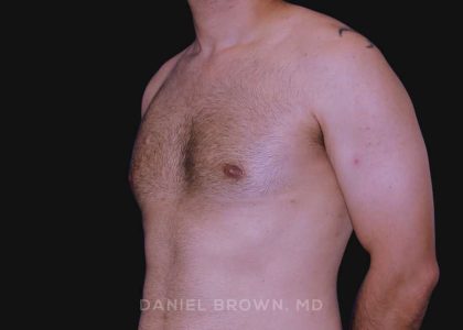 Gynecomastia Before & After Patient #10011