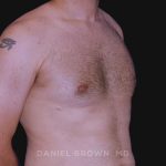 Gynecomastia Before & After Patient #10011