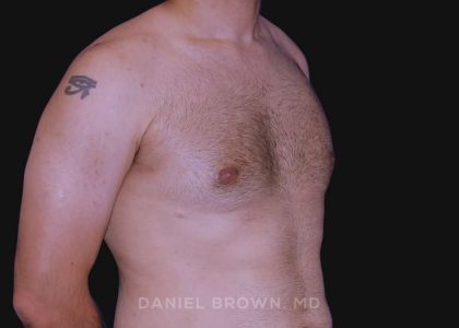 Gynecomastia Before & After Patient #10011