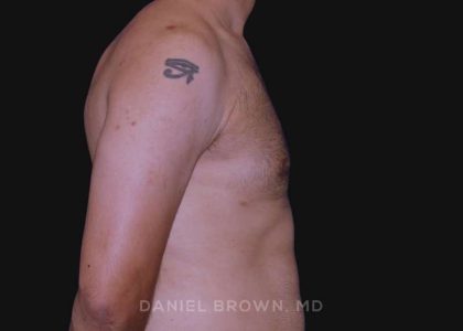 Gynecomastia Before & After Patient #10011