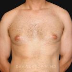 Gynecomastia Before & After Patient #10011