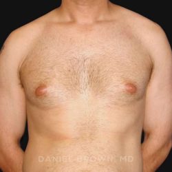 Gynecomastia Before & After Patient #10011