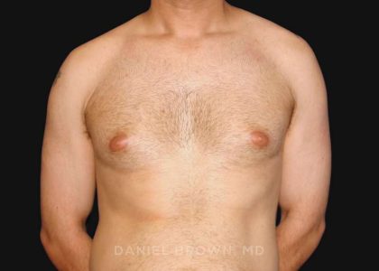 Gynecomastia Before & After Patient #10011