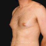 Gynecomastia Before & After Patient #10011