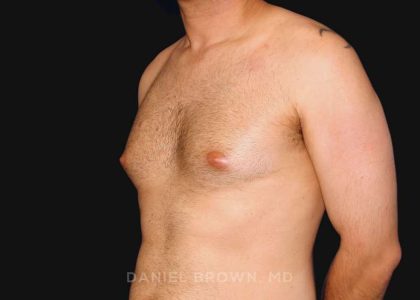 Gynecomastia Before & After Patient #10011