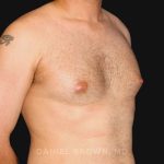 Gynecomastia Before & After Patient #10011
