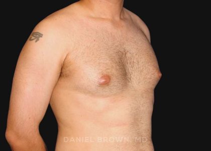 Gynecomastia Before & After Patient #10011