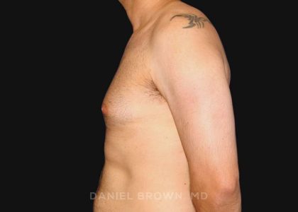 Gynecomastia Before & After Patient #10011