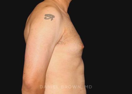 Gynecomastia Before & After Patient #10011