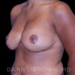 Bellesoma Breast Lift Before & After Patient #8430