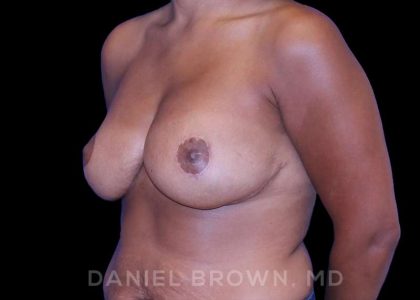 Bellesoma Breast Lift Before & After Patient #8430