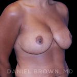 Bellesoma Breast Lift Before & After Patient #8430