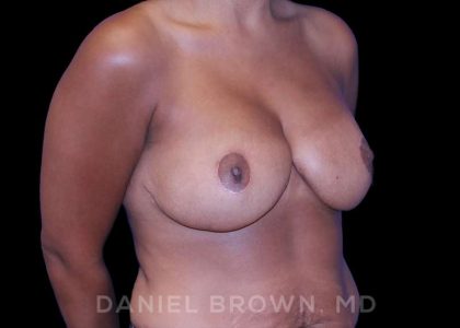 Bellesoma Breast Lift Before & After Patient #8430