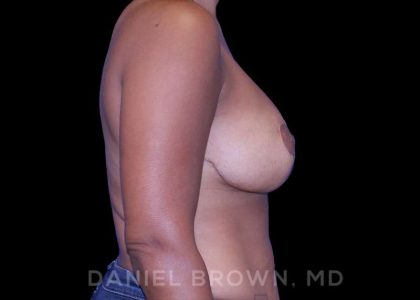 Bellesoma Breast Lift Before & After Patient #8430