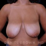 Bellesoma Breast Lift Before & After Patient #8430