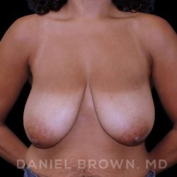 Bellesoma Breast Lift Before & After Patient #8430