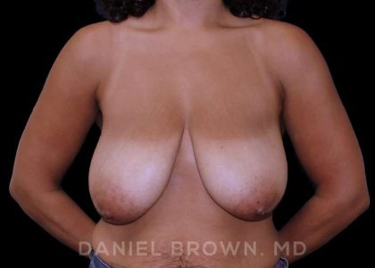 Bellesoma Breast Lift Before & After Patient #8430