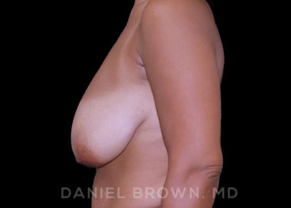 Bellesoma Breast Lift Before & After Patient #8430