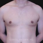 Gynecomastia Before & After Patient #10022