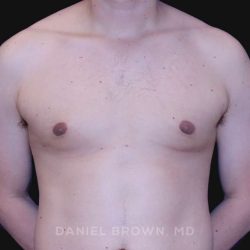 Gynecomastia Before & After Patient #10022