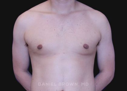 Gynecomastia Before & After Patient #10022