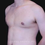 Gynecomastia Before & After Patient #10022