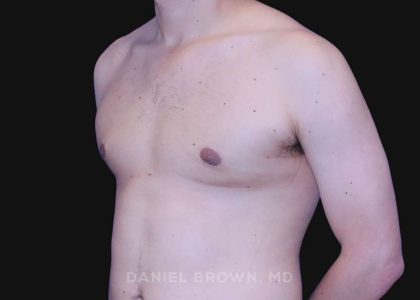 Gynecomastia Before & After Patient #10022