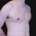 Gynecomastia Before & After Patient #10022