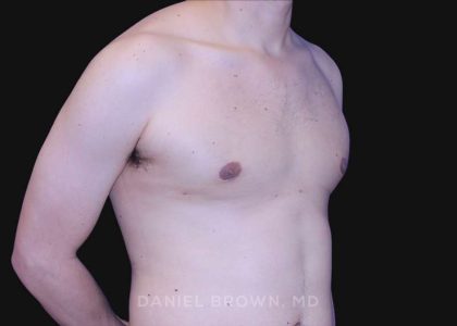 Gynecomastia Before & After Patient #10022