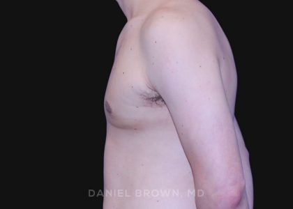 Gynecomastia Before & After Patient #10022