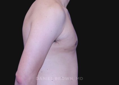 Gynecomastia Before & After Patient #10022