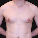 Gynecomastia Before & After Patient #10022