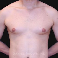 Gynecomastia Before & After Patient #10022