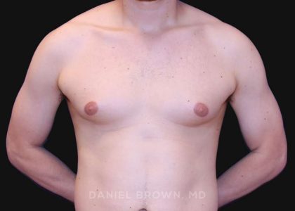 Gynecomastia Before & After Patient #10022
