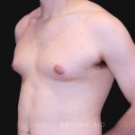 Gynecomastia Before & After Patient #10022