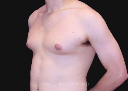 Gynecomastia Before & After Patient #10022