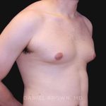 Gynecomastia Before & After Patient #10022