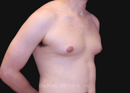 Gynecomastia Before & After Patient #10022
