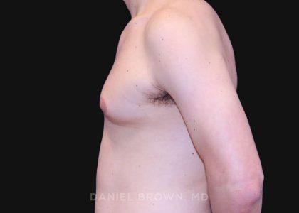 Gynecomastia Before & After Patient #10022