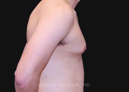 Gynecomastia Before & After Patient #10022