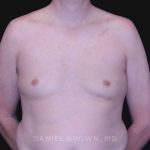Gynecomastia Before & After Patient #10033