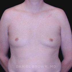 Gynecomastia Before & After Patient #10033