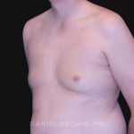 Gynecomastia Before & After Patient #10033