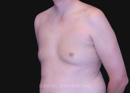 Gynecomastia Before & After Patient #10033